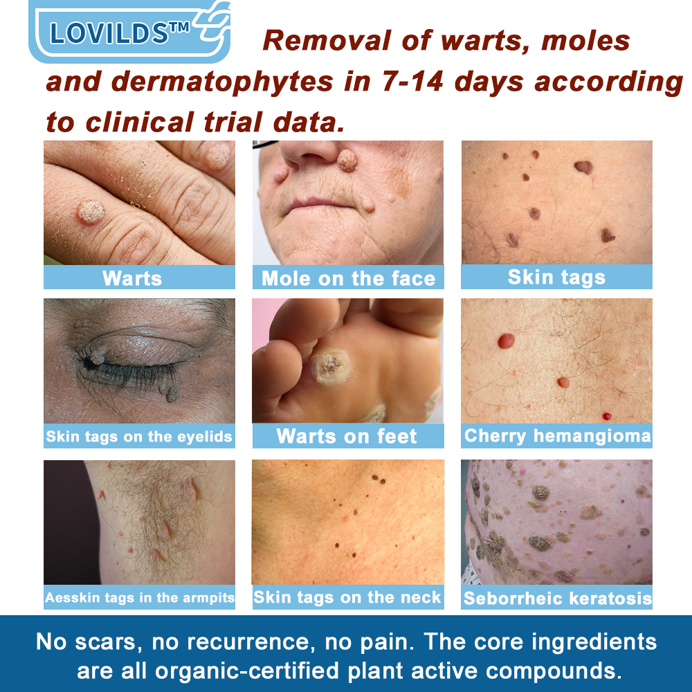 ✅Mayo Clinic Official: LOVILDS® Magnesium skin repair cream (Eczema and Psoriasis Relief, Skin Repair, Even Tone, Acne and Dark Spot Treatment, Wart and Mole Removal)