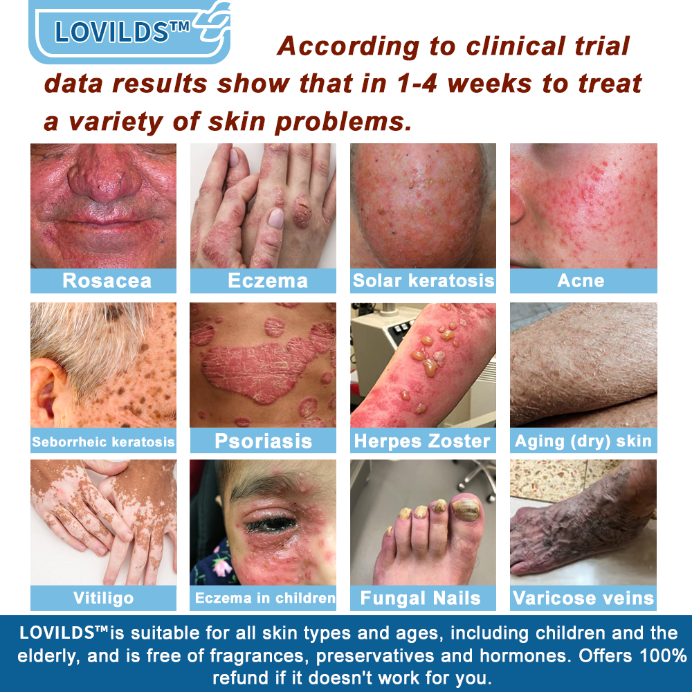 ✅Mayo Clinic Official: LOVILDS® Magnesium skin repair cream (Eczema and Psoriasis Relief, Skin Repair, Even Tone, Acne and Dark Spot Treatment, Wart and Mole Removal)