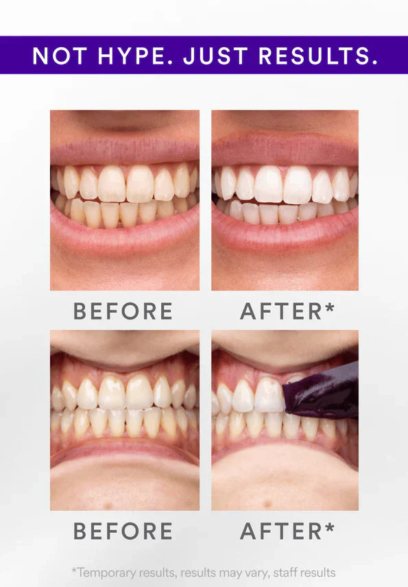 💎Whitening Strips That Show Real Results After Just One Use — 🔥Limited Time 80% OFF🔥