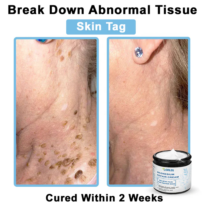 ✅Mayo Clinic Official: LOVILDS® Magnesium skin repair cream (Eczema and Psoriasis Relief, Skin Repair, Even Tone, Acne and Dark Spot Treatment, Wart and Mole Removal)