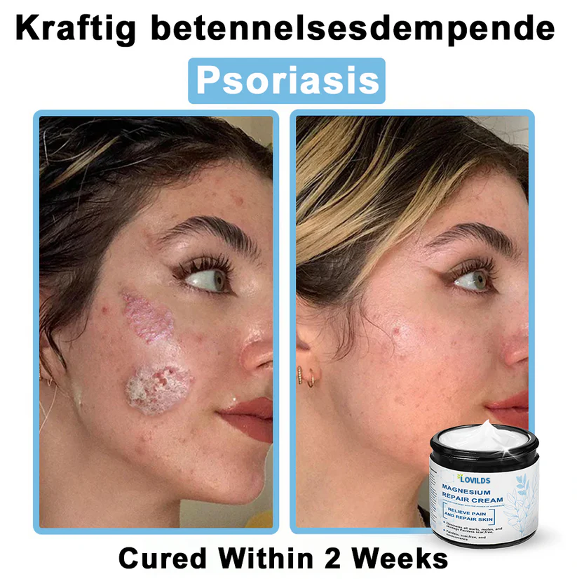 ✅Mayo Clinic Official: LOVILDS® Magnesium skin repair cream (Eczema and Psoriasis Relief, Skin Repair, Even Tone, Acne and Dark Spot Treatment, Wart and Mole Removal)