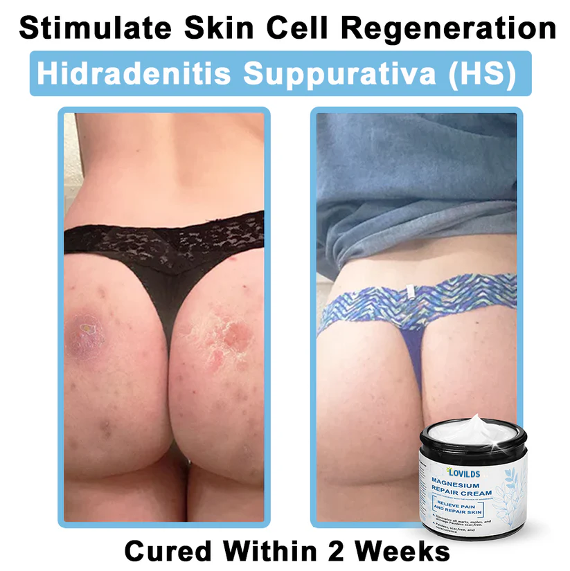 ✅Mayo Clinic Official: LOVILDS® Magnesium skin repair cream (Eczema and Psoriasis Relief, Skin Repair, Even Tone, Acne and Dark Spot Treatment, Wart and Mole Removal)