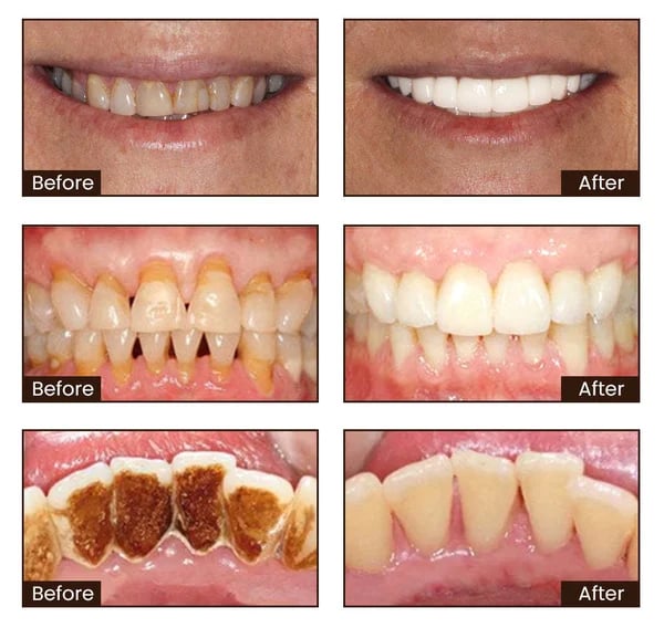 🦷Final 3 Hours: 60% OFF Nicotinamide Whitening Toothpaste🔥